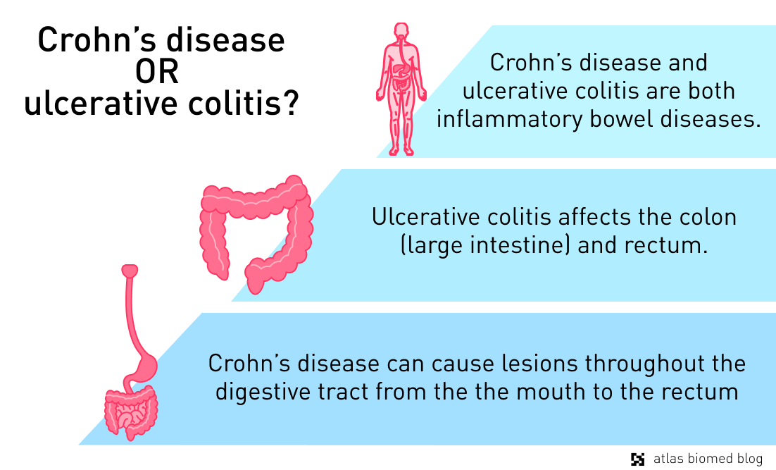 Difference between Crohn's disease and ulcerative colitis